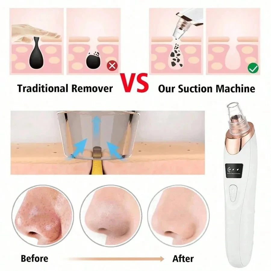 Electric Pore Cleaner & Blackhead Remover – Deep Cleansing Vacuum Device for Face