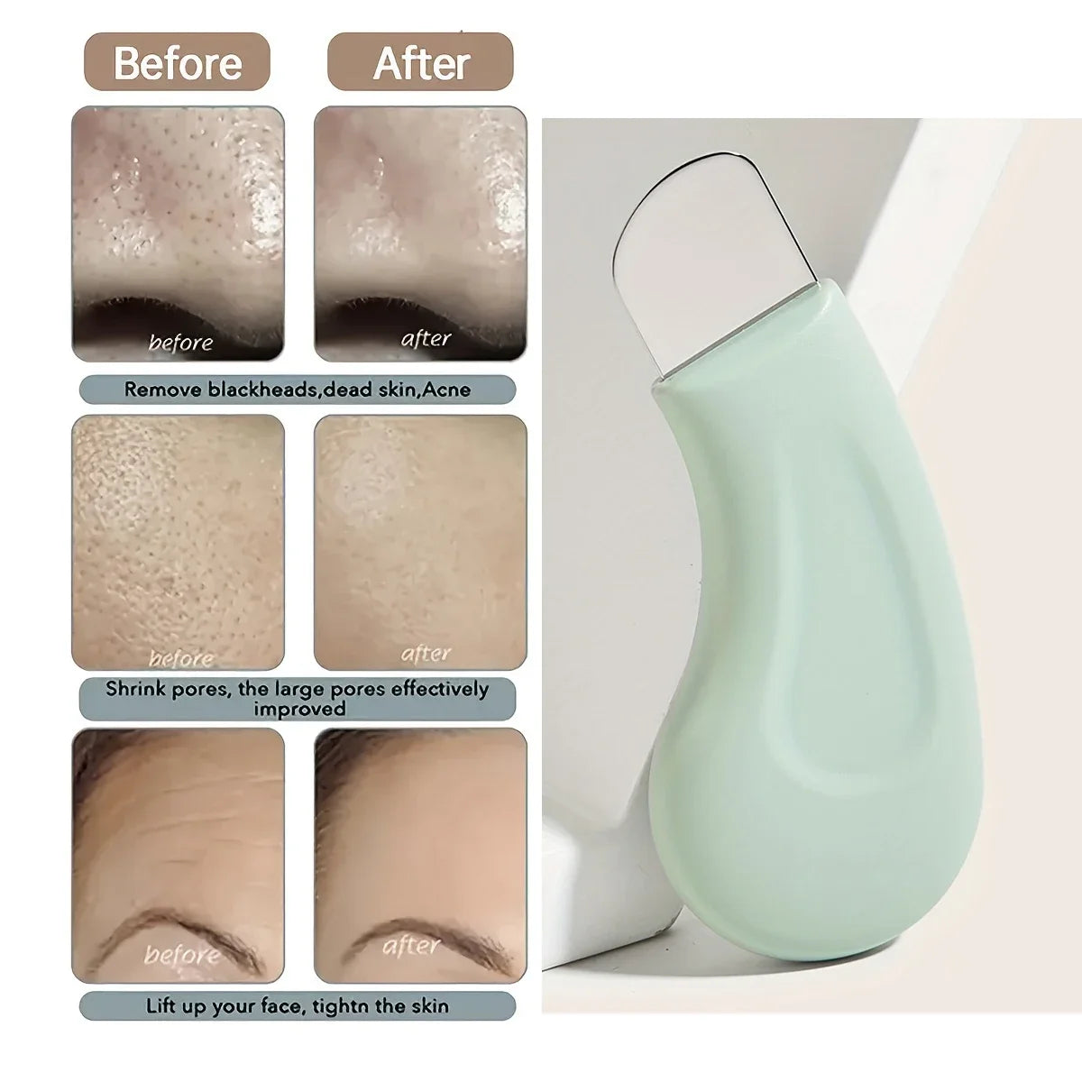 Blackhead & Whitehead Removal Tool for Nose & Face – Pore Cleaner Skin Care Tool for Women